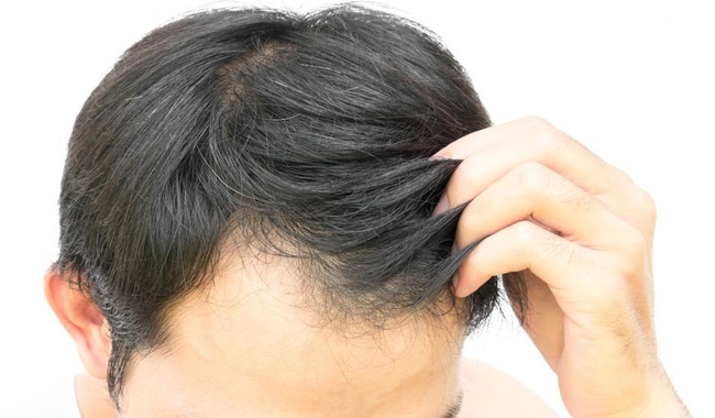 Homeopathy Hair Treatment Is Best Cure On Hair Disease…!!