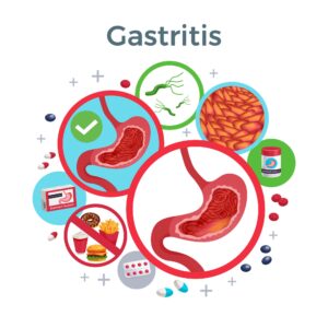 A Case of Acute Gastric Complains